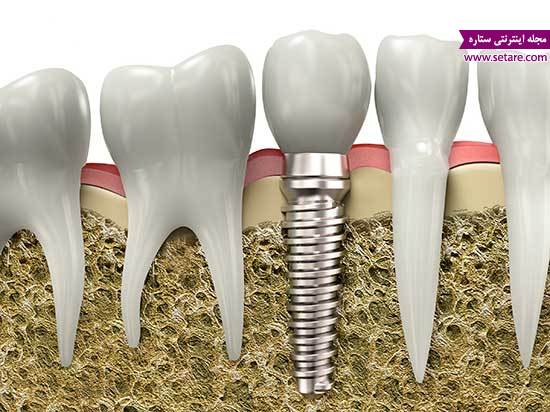 ایمپلنت دندان - هزینه کاشت دندان - قیمت ایمپلنت دندان
