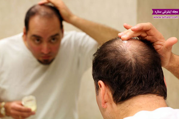 درمان ریزش مو در طب سنتی، طاسی، رویش مجدد مو، داروی گیاهی