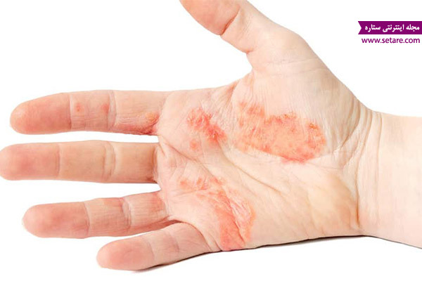 اگزما دست، حساسیت پوستی، طب سنتی