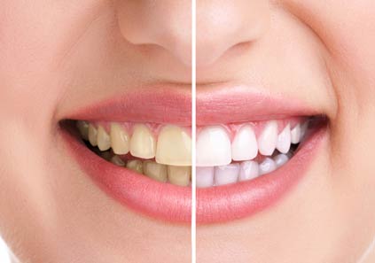 بلیچینگ دندان چیست؟ - سفید کردن دندان به روش بلیچینگ - ستاره