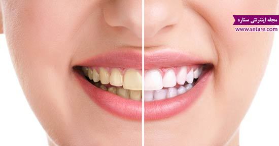 بلیچینگ دندان - سفید کردن دندان - دندانپزشکی - 
