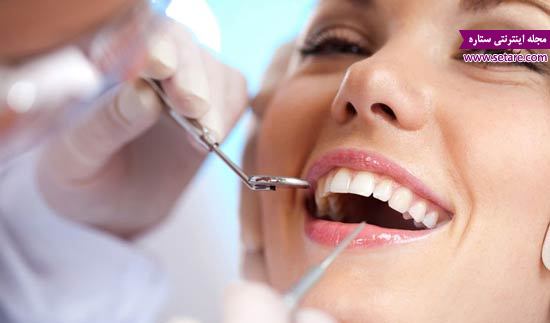بلیچینگ دندان چیست؟ - سفید کردن دندان به روش بلیچینگ