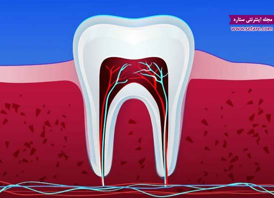 درمان ریشه دندان عفونی – جراحی ریشه دندان – هزینه درمان ریشه دندان