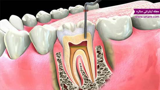 عصب کشی دندان – درمان ریشه دندان – روت کانال تراپی 