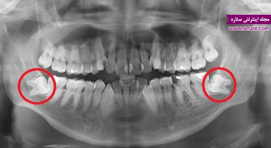 دندانپزشکی ارزان – دندان عقل نهفته – کشیدن دندان 