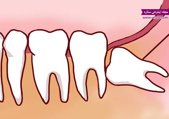 دندان عقل – دندانپزشکی – مشکلات دندانپزشکی 