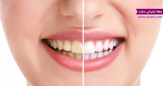 بیماریهای دندان – مشکلات دندان – لکه دندان – زرد شدن دندان – درد دندان – ترمیم دندان