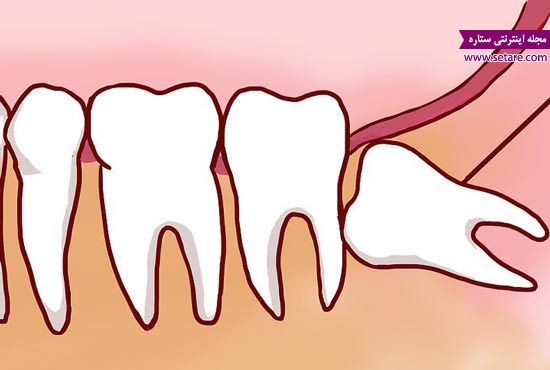 دندان عقل – دندان عقل نهفته – بیماری های دندان – مشکلات دندان – دندانپزشکی ارزان 