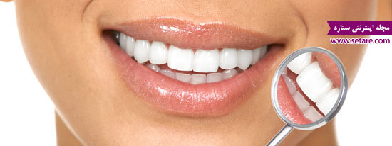 اصلاح طرح لبخند – کامپوزیت ونیر – لمینت دندان 