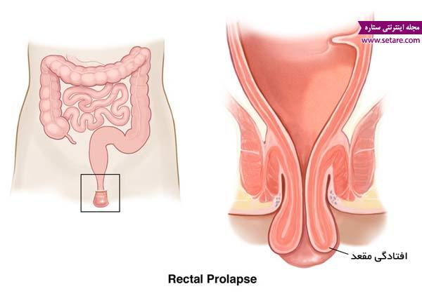 علت پرولاپس رکتوم (افتادگی مقعد) چیست؟ - Rectal prolapse