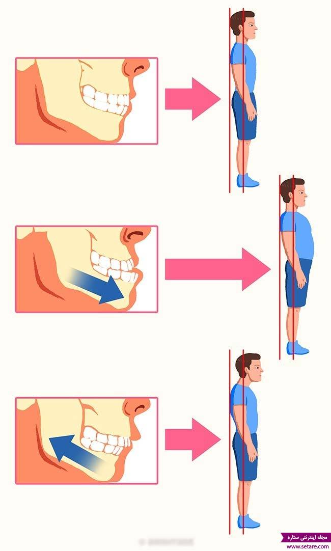 عکس انسداد دندانی و تاثیر آن بر خمیدگی کمر