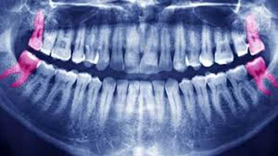 دندان عقل (اهمیت و مشکلات)