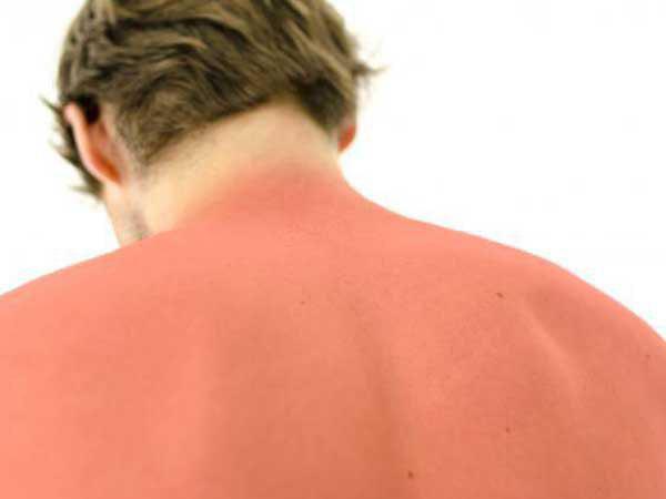سرخی بیش از حد پوست از نشانه های آفتاب سوختگی است