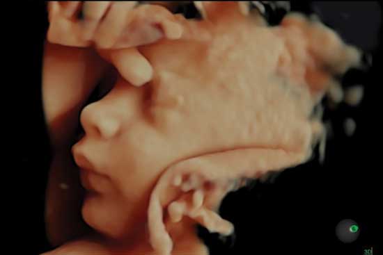 اسکن ناهنجاری های حیاتی جنین در سونوگرافی آنومالی مشخص می شود