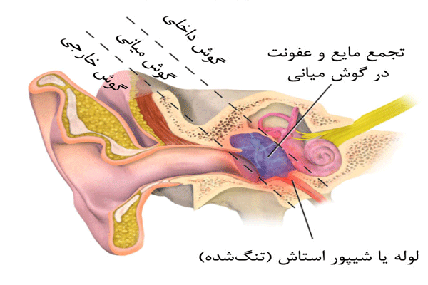 عفونت گوش داخلی 