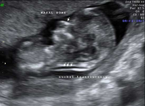 در سونوگرافی بررسی سلامتی جنین از جهت ابتلا به سندرم داون نیز بررسی می شود