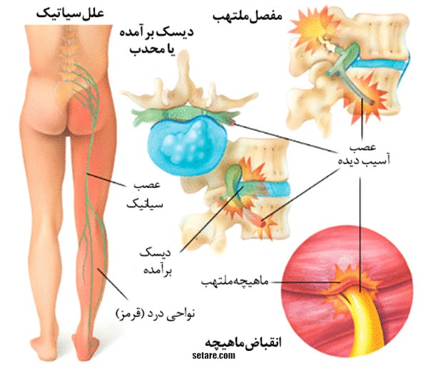 علت و عوامل درد سیاتیک