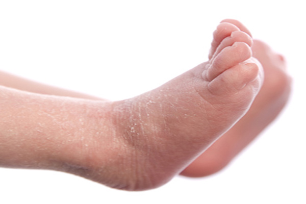 خشکی پوست نوزاد را چگونه درمان کنیم؟