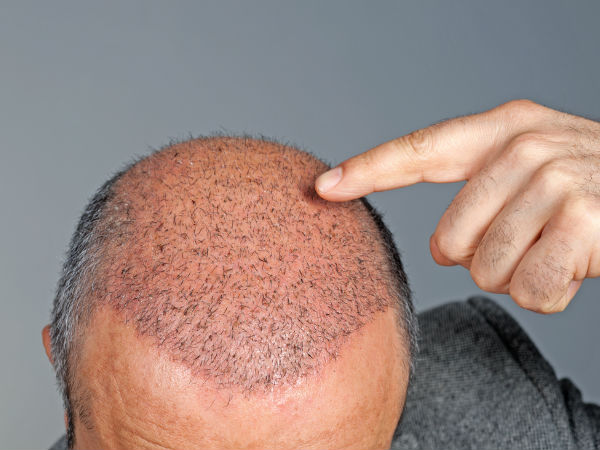 اثرات جانبی کاشت مو چیست ؟