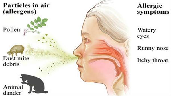  آلرژی آسم