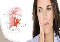 کیست دندان چیست؟ + علت علائم و راه های درمان