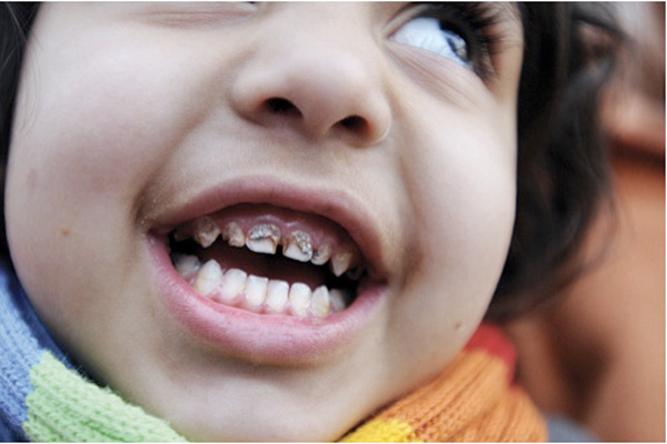 زمان افتادن دندان شیری چه موقع است؟