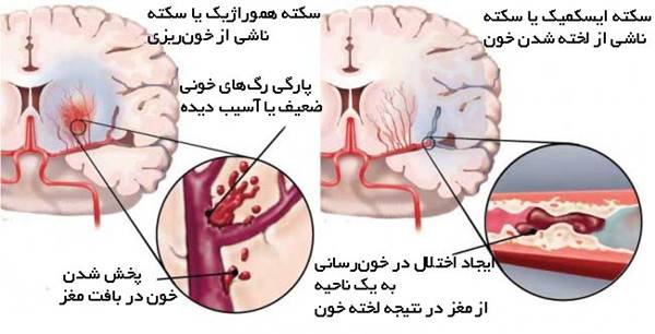 علائم سکته مغزی 