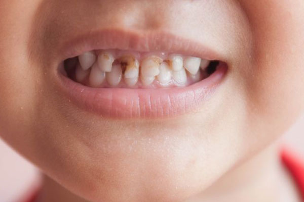 علل فساد و پوسیدگی دندان شیری کودکان چیست؟