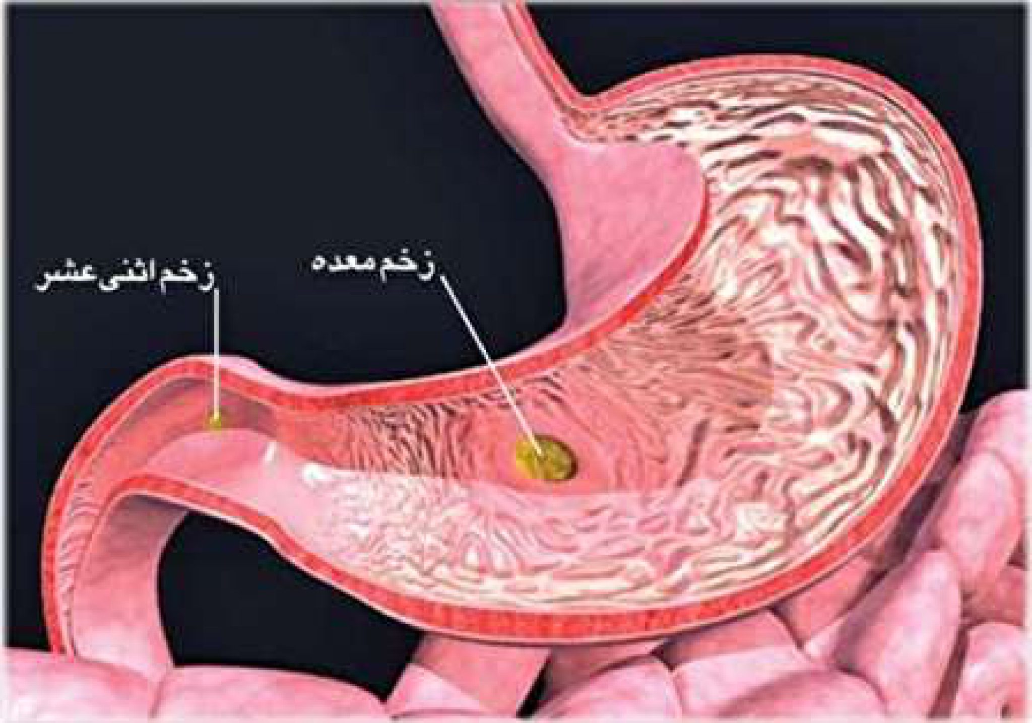 Тотальный желудка. Каллезная язва желудка. Фолликулярный дуоденит. Хронический гастрит дуоденит.