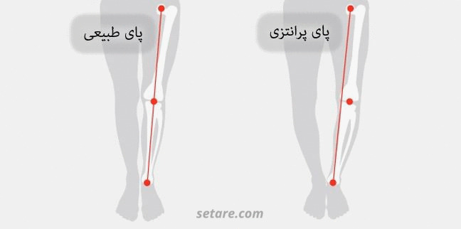 درمان پاهای پرانتزی با زانوبند طبی