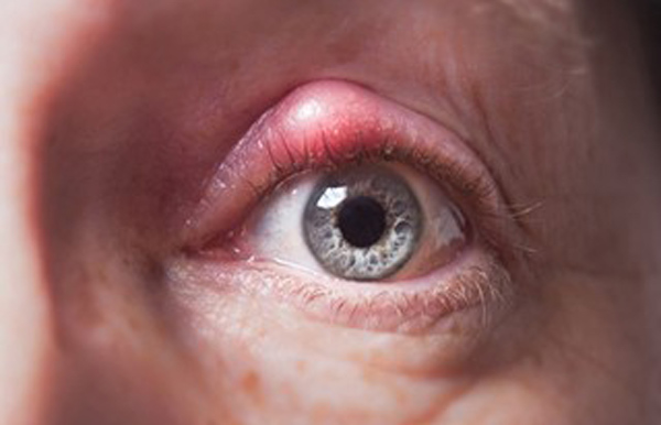 علائم سرطان پوست در چشم