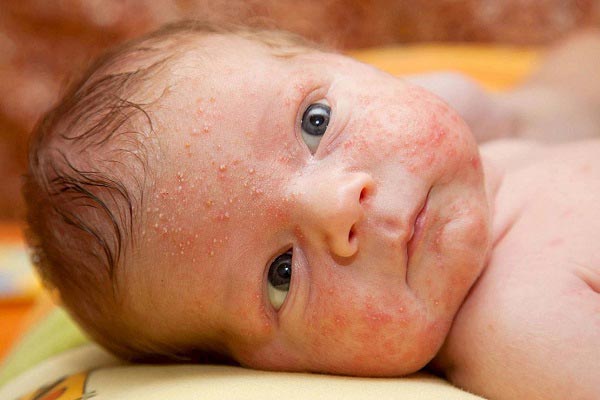 آلرژی پوستی در نوزادان 