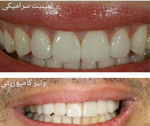 تفاوت کامپوزیت و لمینت دندان در چیست؟