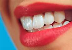 ونیر کامپوزیت چیست و چه چه مزایا و معایبی دارد؟