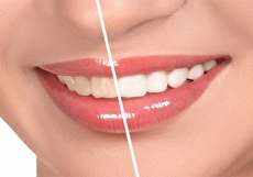 تفاوت کامپوزیت و لمینت دندان در چیست؟