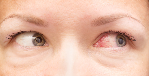 تشخیص آلرژی چشم