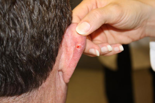 علائم سرطان پوست در گوش