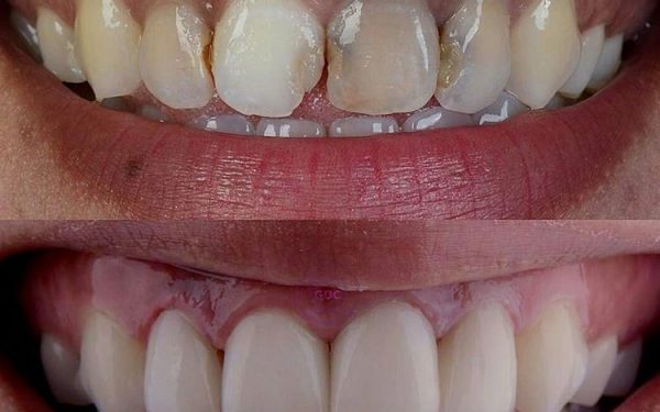 ونیر کامپوزیت و زیبایی دندان ها 