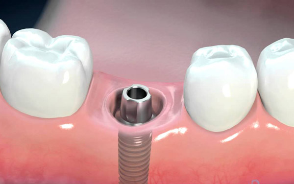 مراحل جراحی ایمپلت دندان