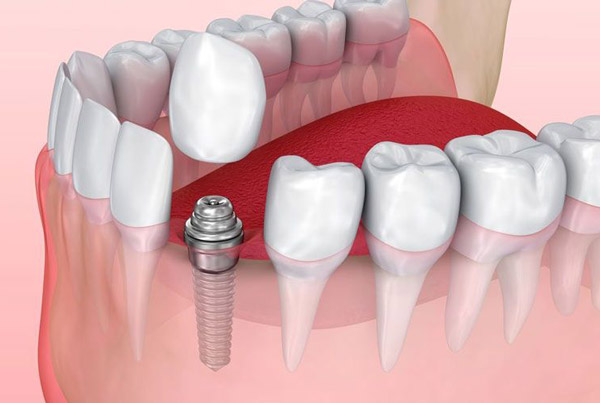 روش انجام ایمپلت دندان