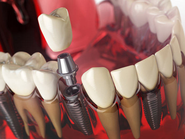 مراحل ایمپلت دندان