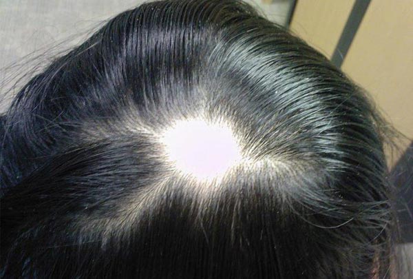  از پیاز عنصل در ناحیه ای که مو به صورت سکه ای ریزش دارد استفاده می کنند. 