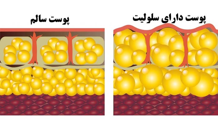 سلولیت ران پا پدیده ای است که در آن توده های چربی در زیر پوست تجمع می یابند.