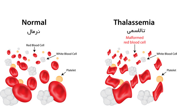 تشخیص تالاسمی در آزمایش خون