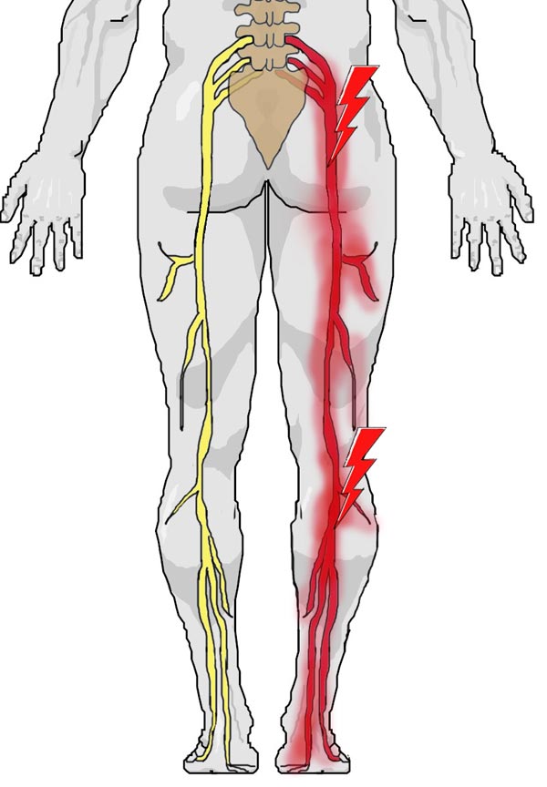عصب سیاتیک از قسمت پشت لگن تا قوزک هر دو پا امتداد دارد و طولانی‌ترین عصب بدن است. 