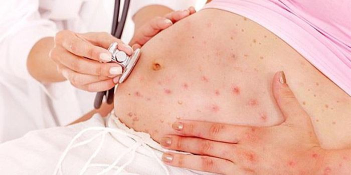 خطرات آبله مرغان در بارداری خطرات آبله مرغان در بارداری و پیشگیری از آن