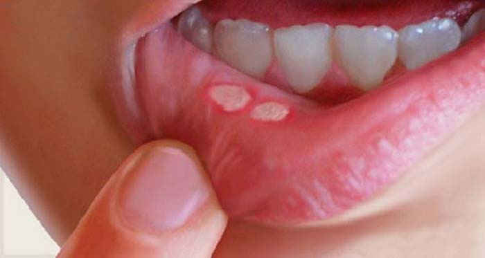زخم دهان همان آفت های دهان هستند که در قسمت داخلی لب ها، داخل دهان یا قسمت داخلی گونه ها و بر روی لثه ظاهر می شوند.