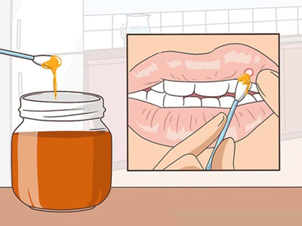 استفاده از عسل در درمان زخم دهان