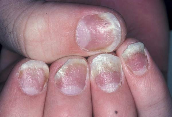 علائم پسوریازیس ناخن در دست‌ها و پا‌ها می‌تواند بروز کند و باعث تغییراتی در آن‌ها شود.