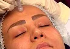 مزوتراپی پوست صورت چیست و چه مزایا و عوارضی دارد؟